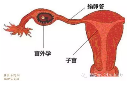 呼和浩特妇科医院：做什么检查能查出宫外孕